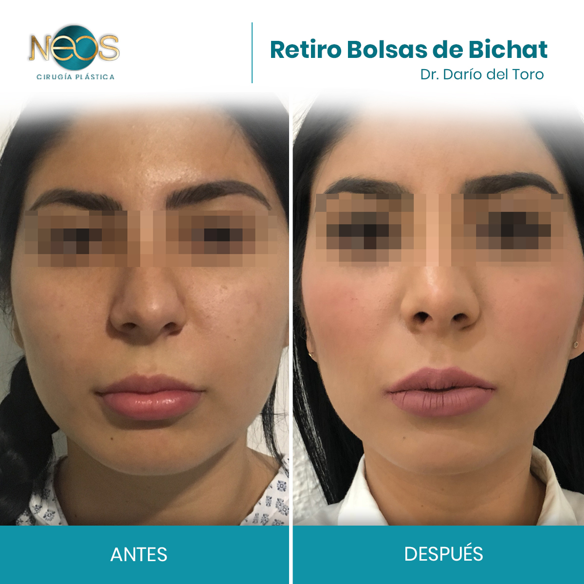 📌 Bichectomía para Hombres y Mujeres en Guadalajara